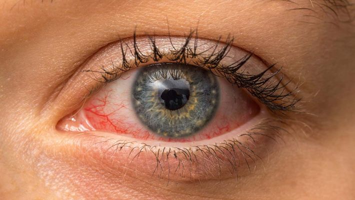 Как связаны коронавирус и конъюнктивит?