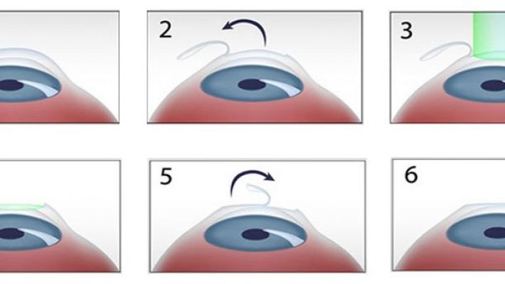 Не всем можно делать лазерную операцию и вот почему…